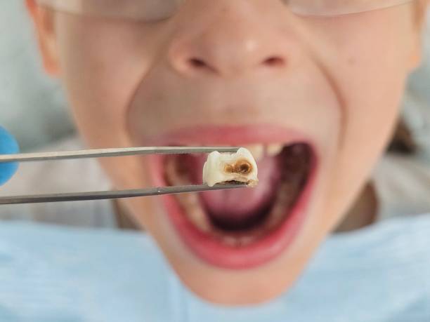 Best Emergency Dental Care for Broken or Chipped Teeth in Rosanky, TX